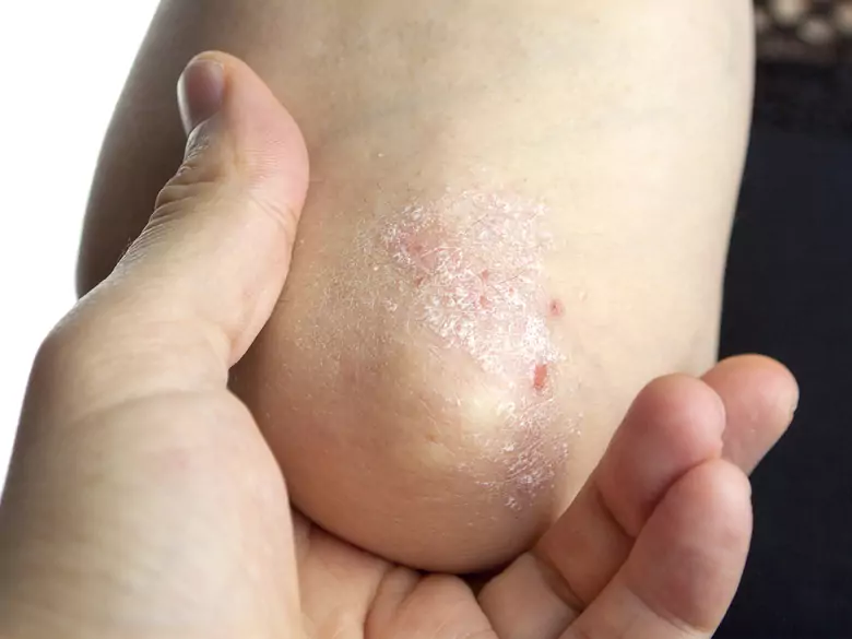 Łuszczycowe zapalenie stawów chorobą stygmatyzującą